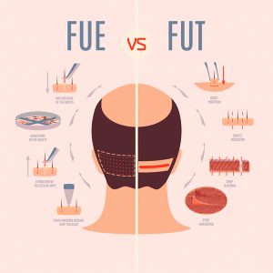 fue or fut hair transplation